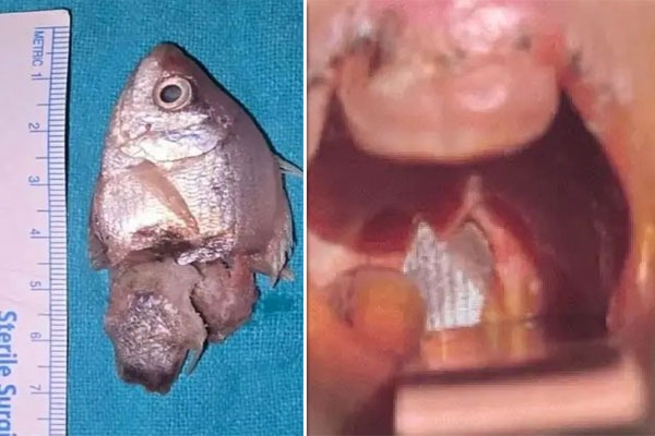 Indore Baby Saved After Aquarium Fish Gets Stuck in Throat