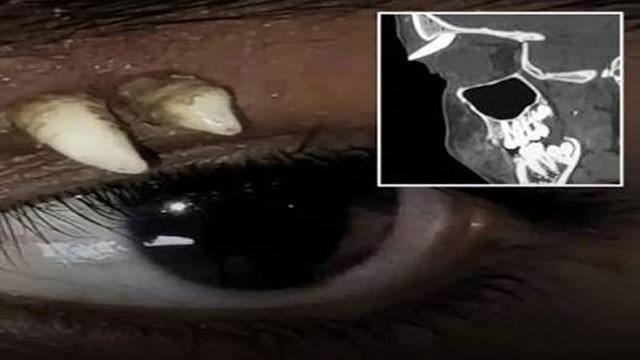Tooth in eye rare incident in medical history doctors stunned