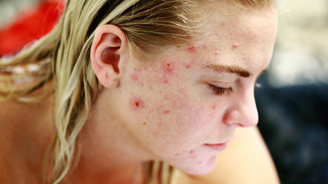 Skin Care Acne and Rashes on Skin Know the Real Causes and Prevention