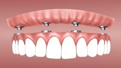 Dental implants cause of stubborn infections revealed by scientists
