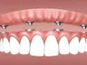 Dental implants cause of stubborn infections revealed by scientists