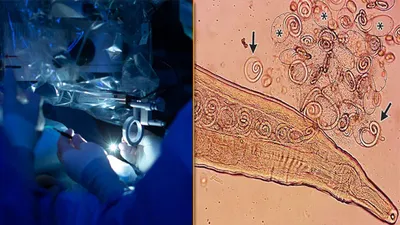 Elderly man visits hospital for vision loss worms moving in eyes doctors shocked